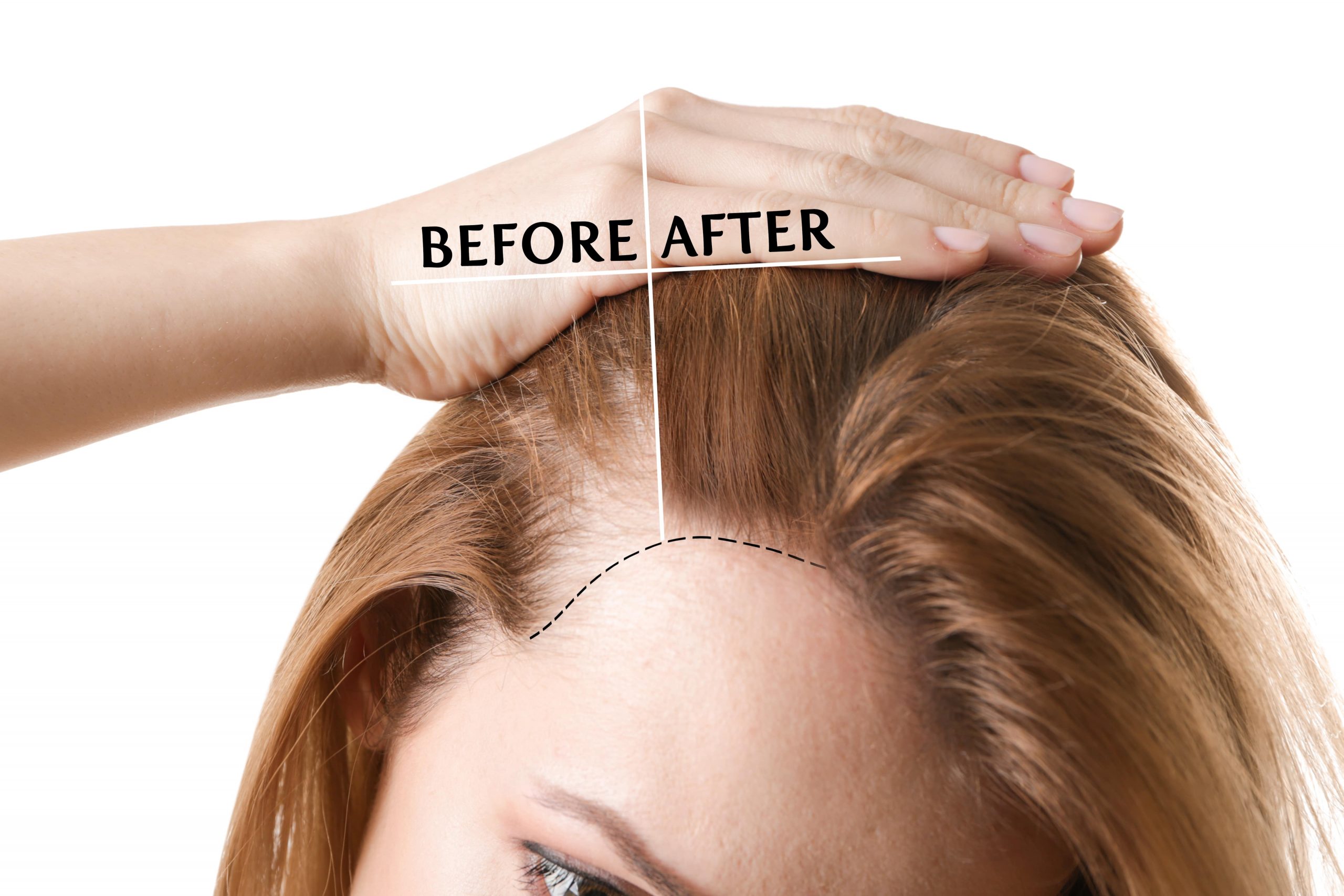 Hair Loss On Temples Causes Symptoms Treatments Hairmd