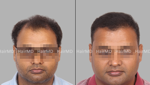 Best Hair Transplant Specialist | Clinic | Doctors in Pune | Book  Consultation Now