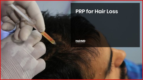 Is PRP effective for Hair Loss?