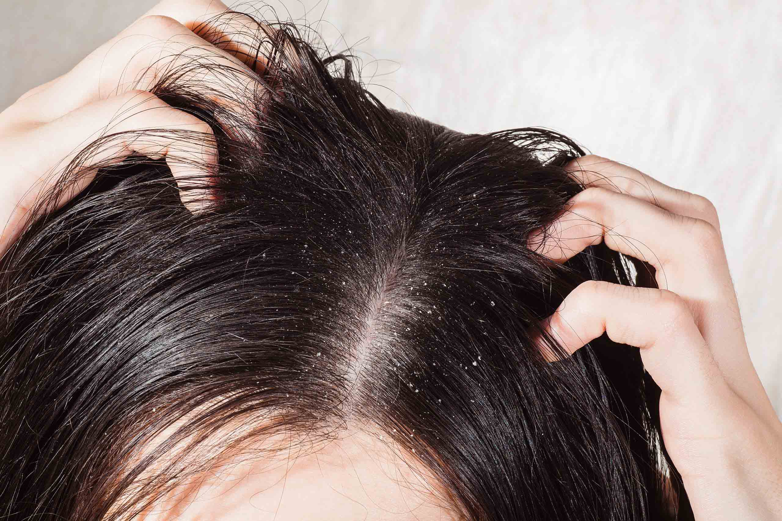 Dry Scalp: What Causes a Flaky, Itchy Scalp? Here's How to Treat and  Prevent It | Glamour