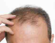 a-man-experiencing-hair-loss-1
