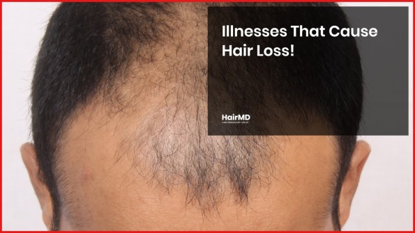 How to remove scabs after Hair Transplant? - hairmd