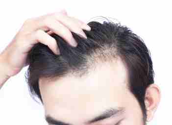 vitamin-d-deficiency-can-lead-to-hair-loss
