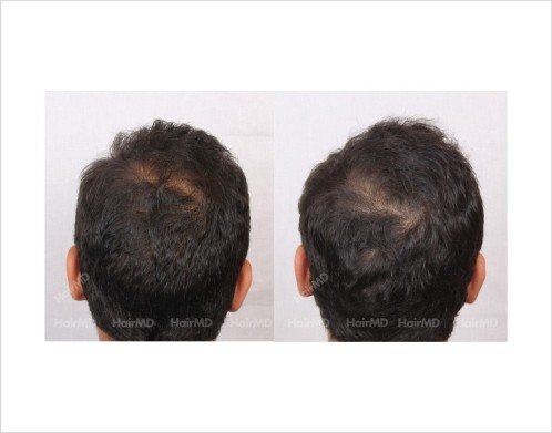 10Hair-Loss-male-before-and-after-result-5