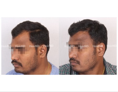 111Hair-Transplant-male-before-after-5000-hair-grafts-15