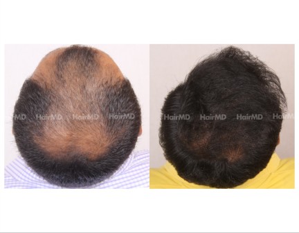 115Hair-Transplant-male-before-after-6000-hair-grafts-26