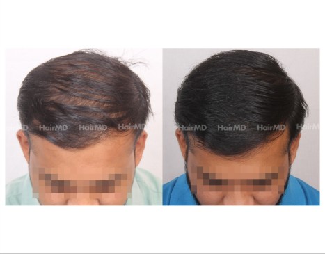 119Hair-Transplant-male-before-after-6000-hair-grafts-23