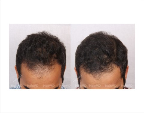 11Hair-Loss-male-before-and-after-result-4