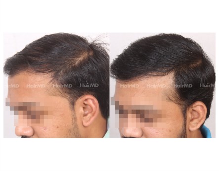 120Hair-Transplant-male-before-after-6000-hair-grafts-24