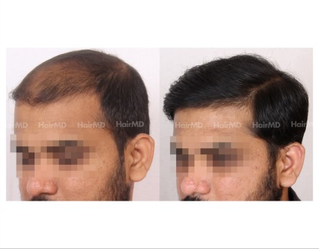 127Hair-Transplant-male-before-after-6000-hair-grafts-16