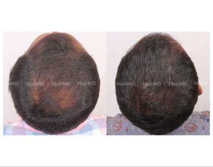 129Hair-Transplant-male-before-after-6000-hair-grafts-13