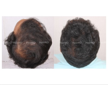 137Hair-Transplant-male-before-after-6000-hair-grafts-8