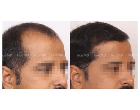 169Hair-Transplant-male-before-after-7000-hair-grafts-14