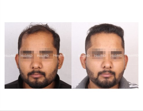 177Hair-Transplant-male-before-after-7000-hair-grafts-6