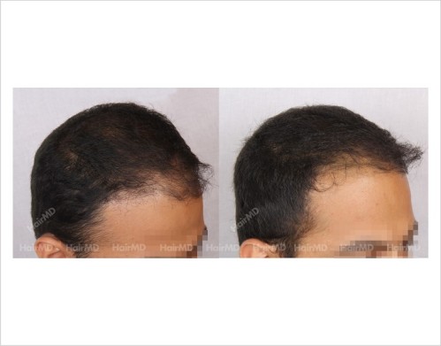 17Hair-Loss-male-before-and-after-result-16