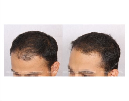 18Hair-Loss-male-before-and-after-result-17