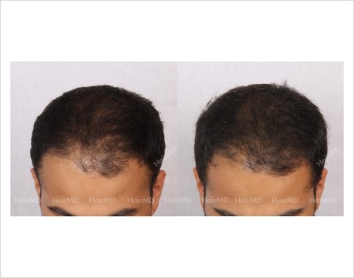 19Hair-Loss-male-before-and-after-result-18