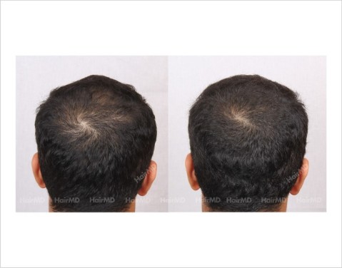 21Hair-Loss-male-before-and-after-result-20