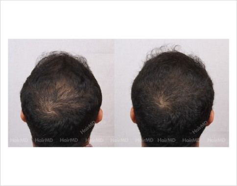 22Hair-Loss-male-before-and-after-result-21