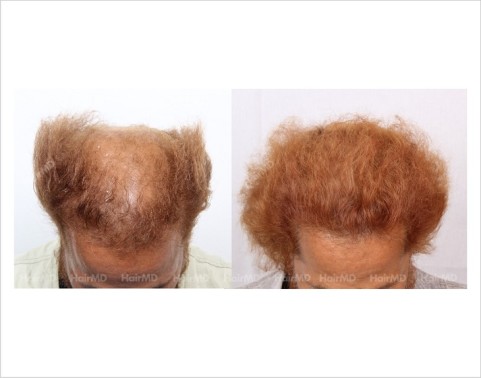 27Hair-Loss-male-before-and-after-result-26