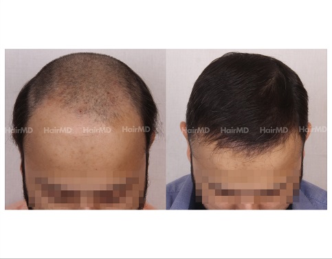 2Hair-Transplant-male-before-after-4000-hair-grafts-29