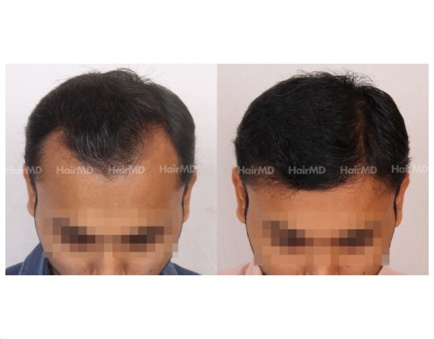 30Hair-Transplant-male-before-after-5000-hair-grafts-21