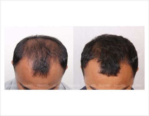 3Hair-Loss-male-before-and-after-result-12
