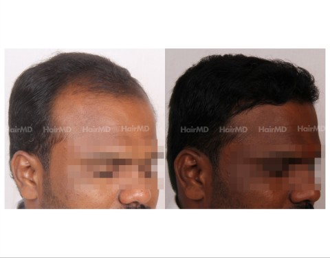55Hair-Transplant-male-before-after-4000-hair-grafts-21