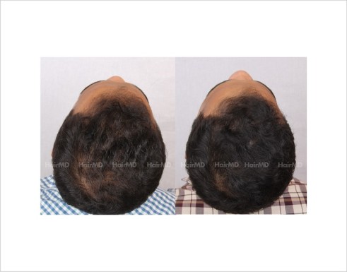 8Hair-Loss-male-before-and-after-result-7