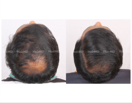 90Hair-Transplant-male-before-after-5000-hair-grafts-10