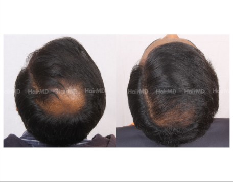 91Hair-Transplant-male-before-after-5000-hair-grafts-11