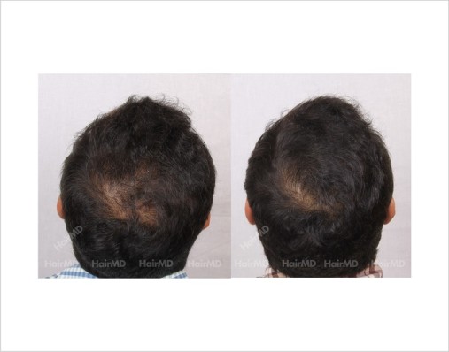Male hair loss treatment - hairmd