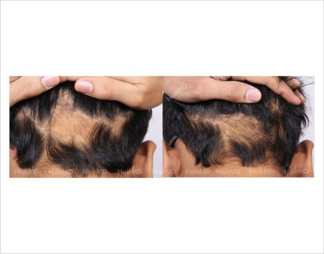Alopecia-Areata-male-scalp-before-after-3