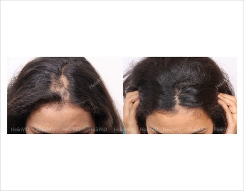 Alopecia-areata-before-after-female-4