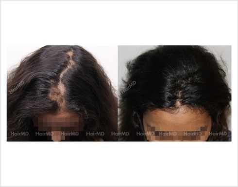 Alopecia-areata-before-after-female-5