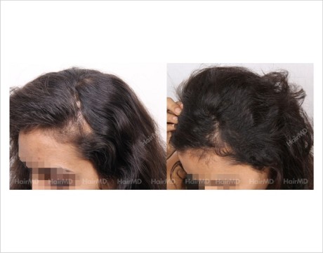 Alopecia-areata-before-after-female-6