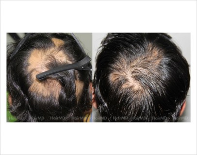 Alopecia-areata-male-scalp-before-after-15