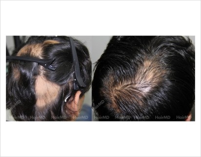 Alopecia-areata-male-scalp-before-after-16