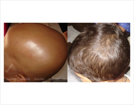 Alopecia-totalis-child-scalp-before-after-result-20