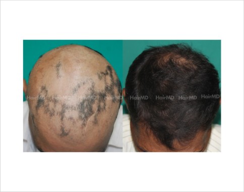 Alopecia-totalis-male-scalp-before-after-result-35