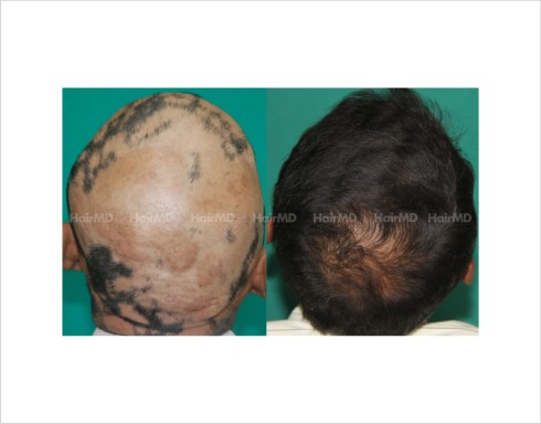 Alopecia-totalis-male-scalp-before-after-result-37