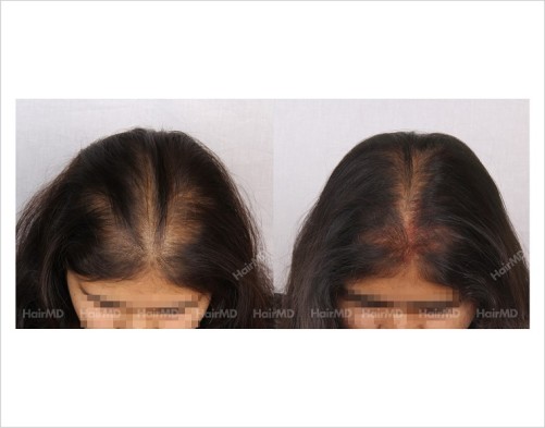 Female-Hair-Loss-before-and-after-result-10
