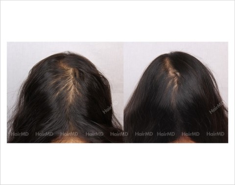 Female-Hair-Loss-before-and-after-result-11