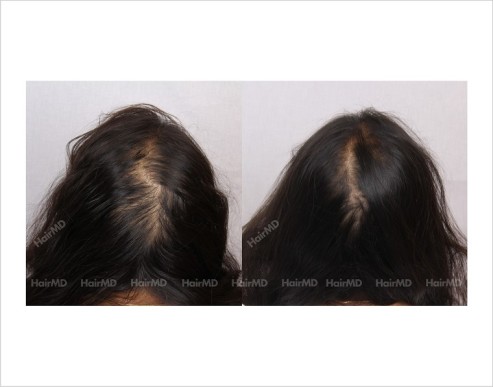 Female-Hair-Loss-before-and-after-result-12