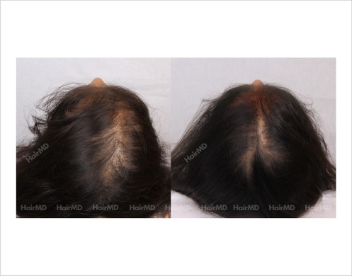 Female-Hair-Loss-before-and-after-result-13