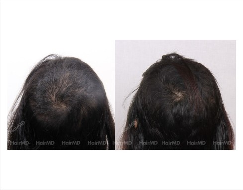 Female-Hair-Loss-before-and-after-result-26