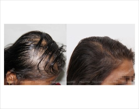 Female-Hair-Loss-before-and-after-result-28
