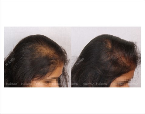 Female-Hair-Loss-before-and-after-result-8