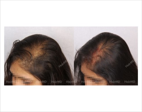 Female-Hair-Loss-before-and-after-result-9