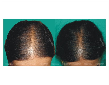 Female-hair-loss-before-after-result-33